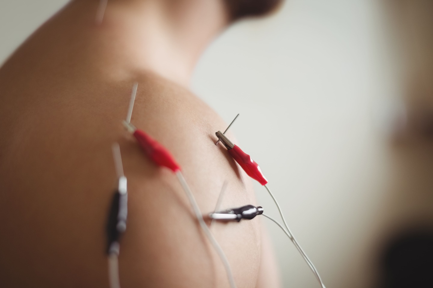 Curso Básico de Neuromodulación Percutánea